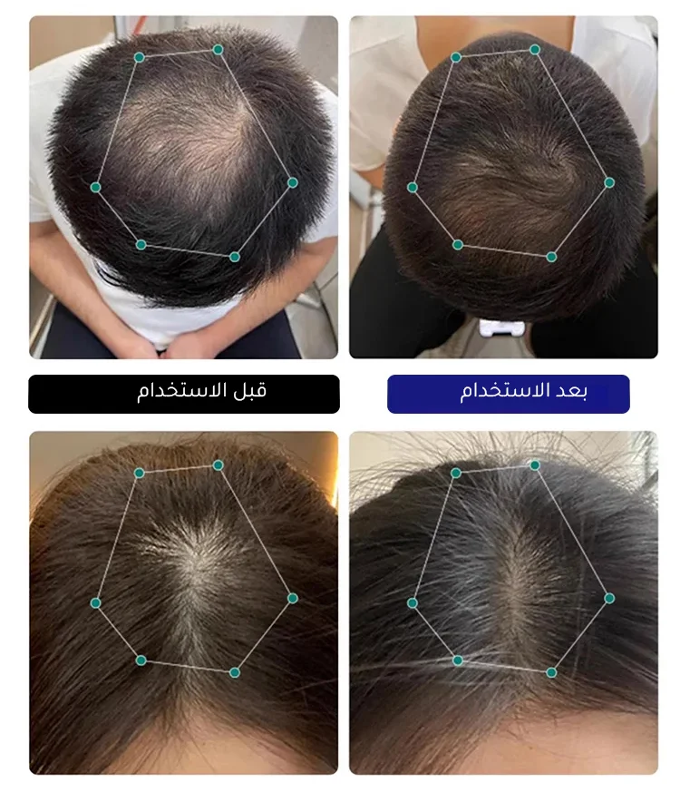 تقليل تساقط الشعر بفاعلية